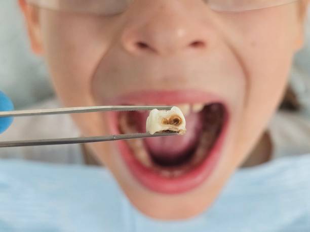 Best Emergency Dental Care for Broken or Chipped Teeth in Kasson, MN